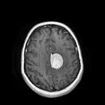تشخیص-تومور-مغزی-با-استفاده-از-پردازش-تصویر-در-متلب