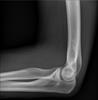 Elbow x ray