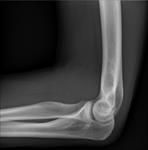 elbow-x-ray
